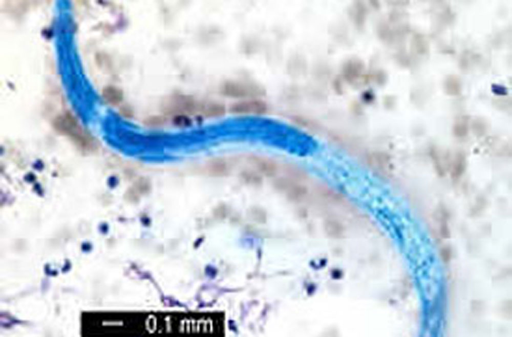 Microscope slide of infectious disease case study