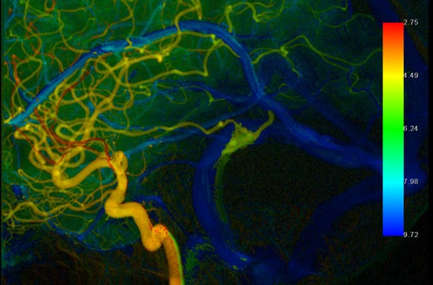 Pulsatile tinnitus imaging