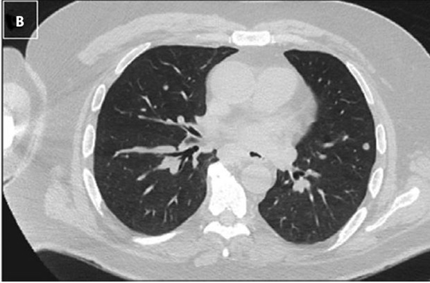 X-ray of air passage