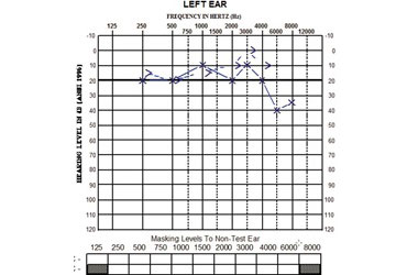 SSD audiogram right ear