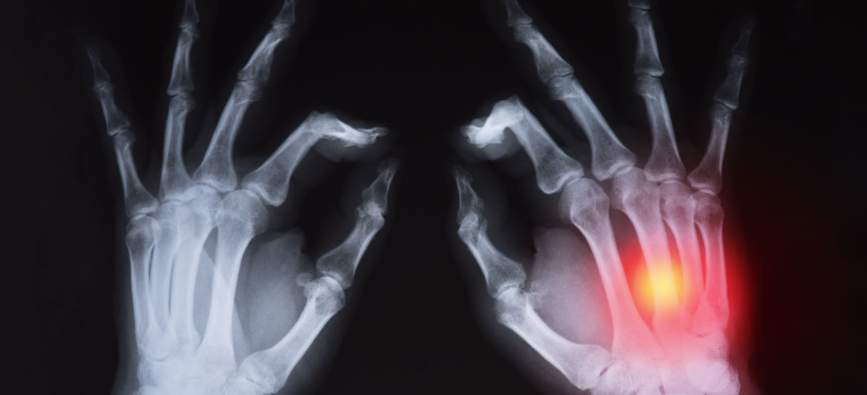 Xray of hands