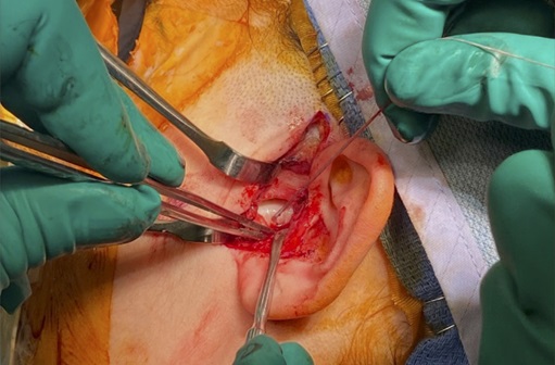 surgery for TMJ
