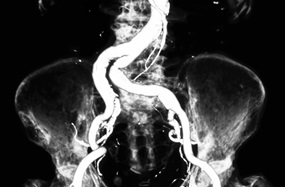 This CT shows the skeletal anatomy of the pelvis and the major attending blood vessels, including the common iliac and aortic arteries
