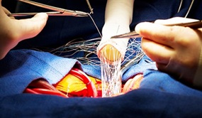 aorta valve surgery