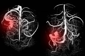 animated Thromboembolism