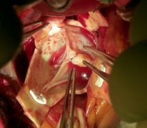 David operation with bicuspid repair