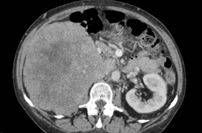 Management of Retroperitoneal Sarcoma