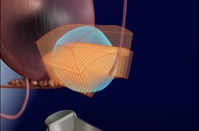 High Intensity Ultrasound image