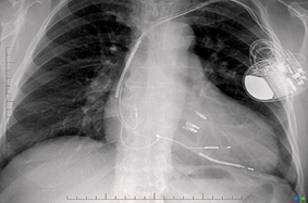 mitraclip xray