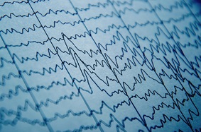 EEG spike-and-wave patterns on monitor