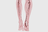 Angiogram demonstrating peripheral artery disease