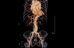 CT scan of abdominal aortic aneurysm