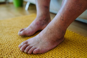 Legs of patient with chronic peripheral artery disease