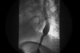 black and white shot of Achalasia