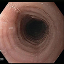 Ringed Esophagus