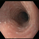 White Plaques in Esophagus