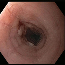 Linear Furrows in Esophagus