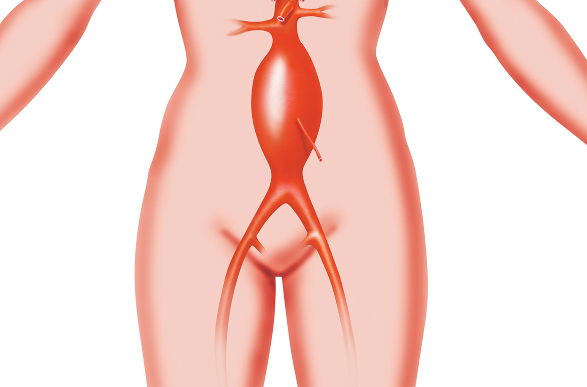 Illustration of an abdominal aortic aneurysm