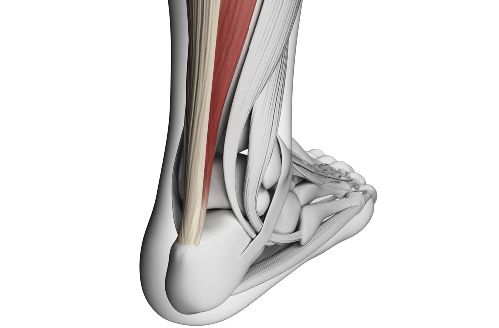 Achilles tendonitis