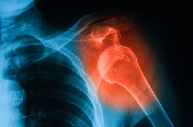 Dislocation injury
