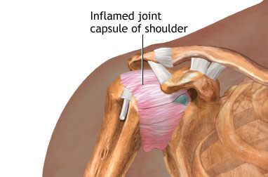 Inflamed joint capsule of shoulder - illustration of shoulder