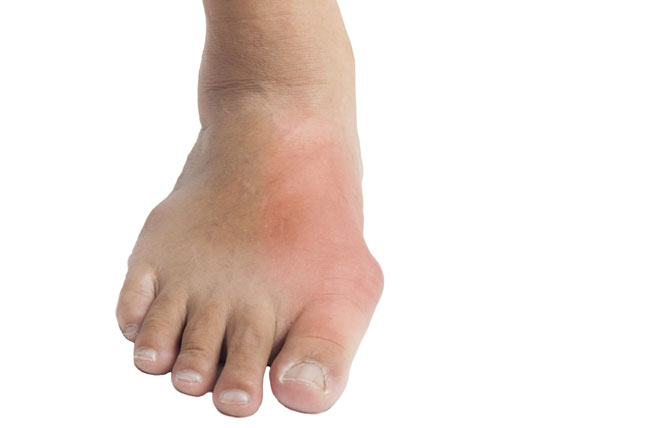 a foot with gout