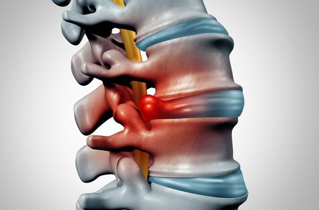 Herniated disc