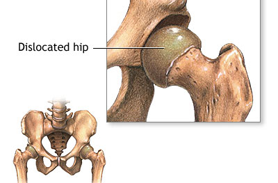 Hip dysplasia