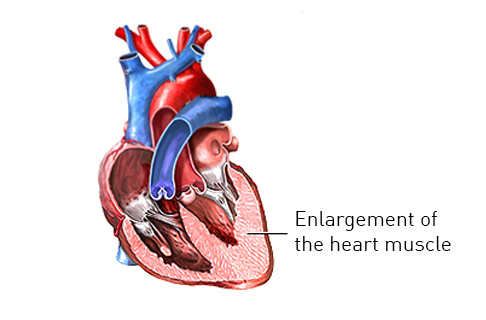 Illustration of hypertrophic cardiomyopathy