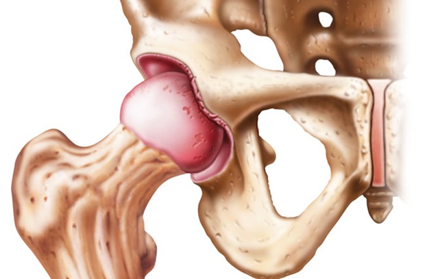 Labral tear