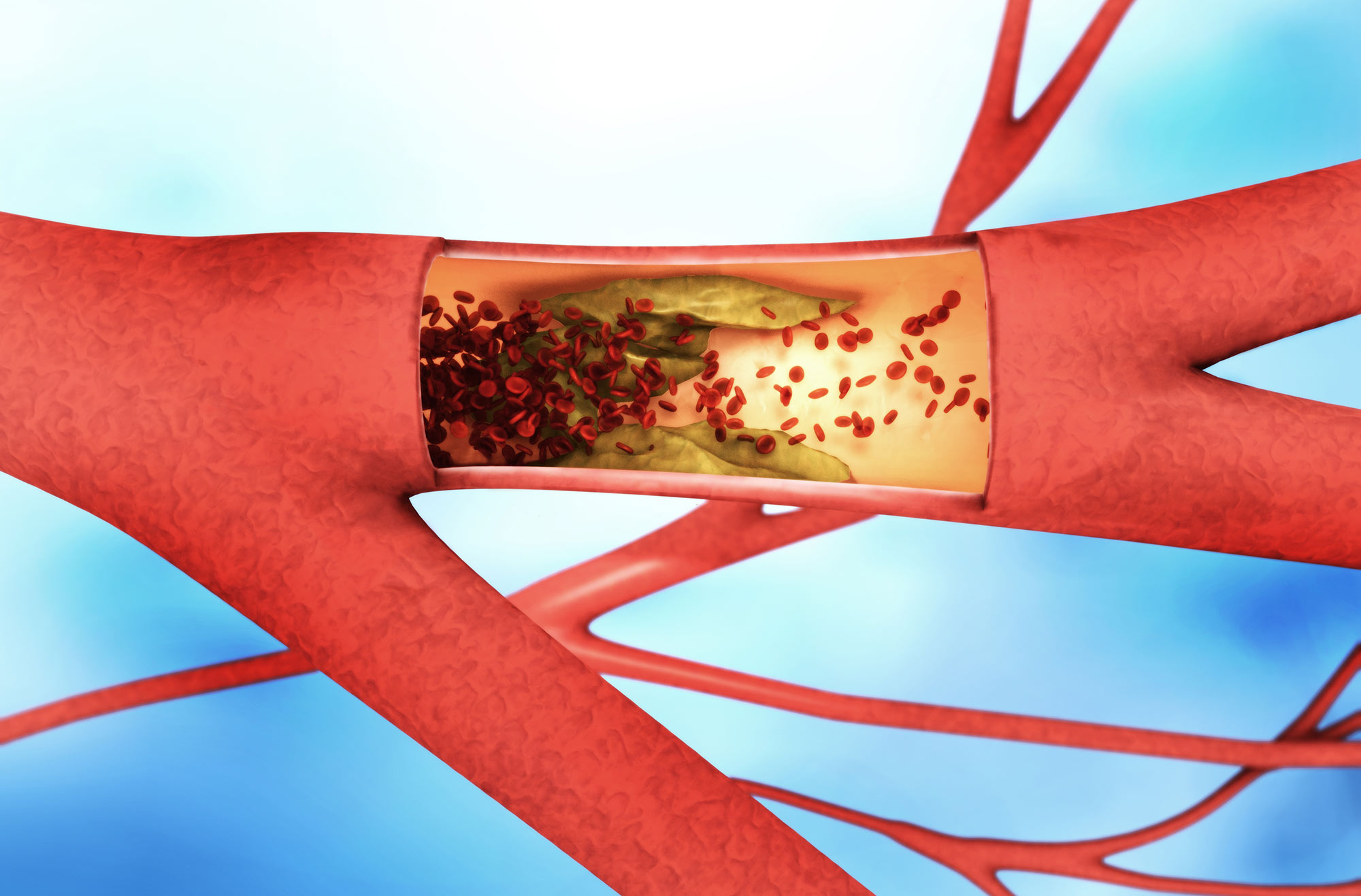 Peripheral artery disease illustration