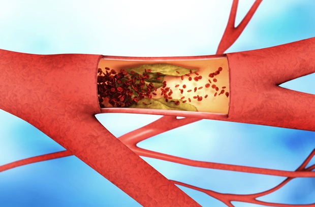 Peripheral artery disease illustration