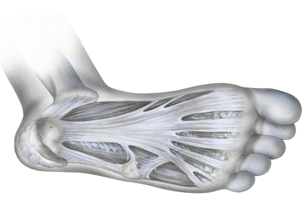 Plantar fasciitis