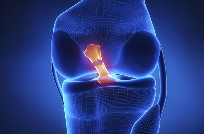 Posterior Cruciate Ligament