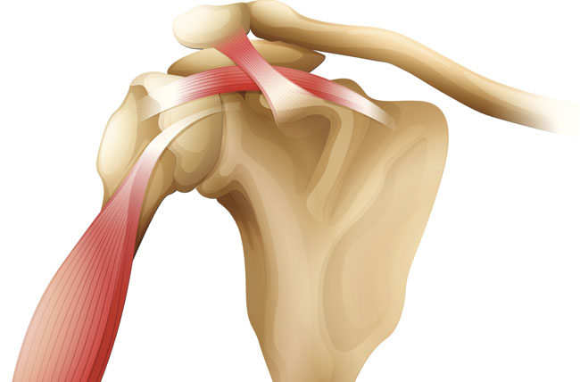 Rotator cuff injury