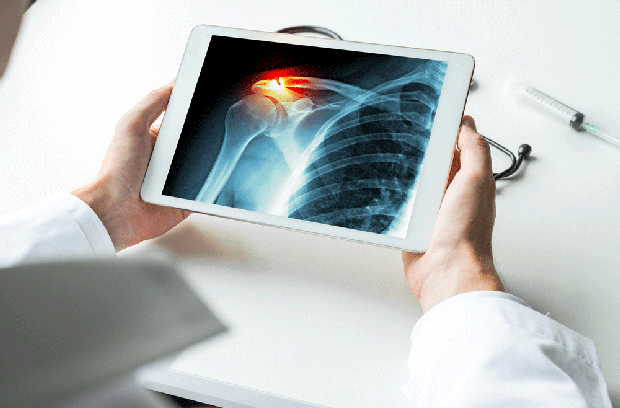Shoulder X-ray
