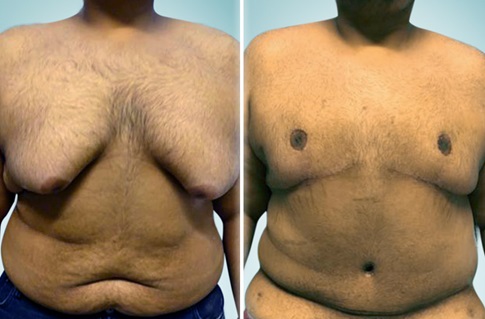 Body contouring, before and after