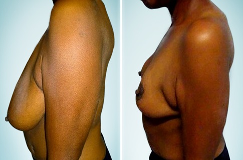 Breast lift, before and after