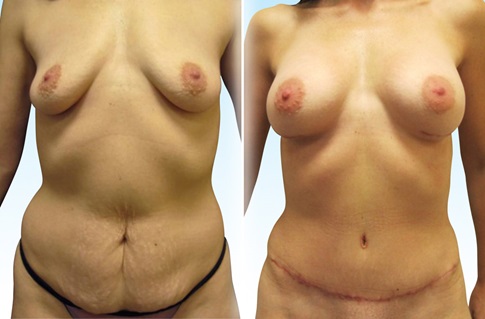 Before and after images of an abdominoplasty