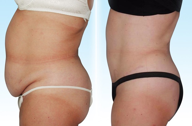 Before and after images of an abdominoplasty