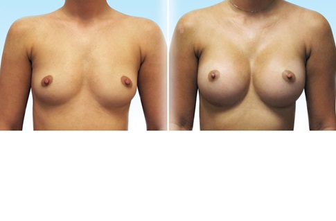 Before and after images of a breast augmentation