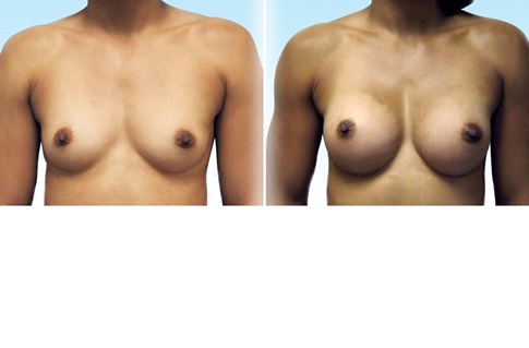 Before and after images of a breast augmentation