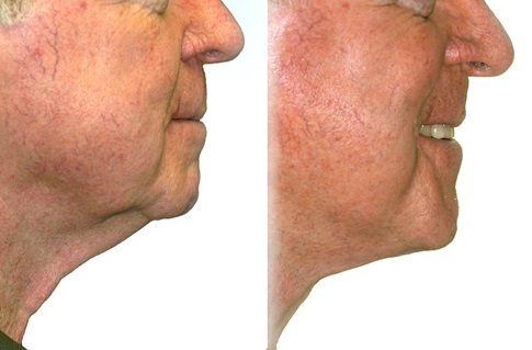 Before and after images of a facelift