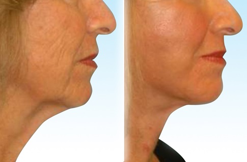 Before and after images of a facelift