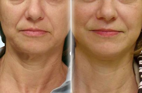 Before and after images of a facelift