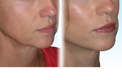 Before and after images of a facelift