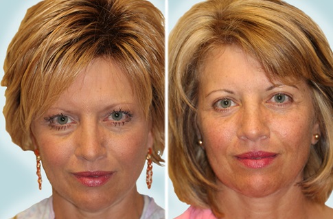 lower eyelid procedure example