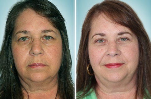 Upper eye lid lift, before and after