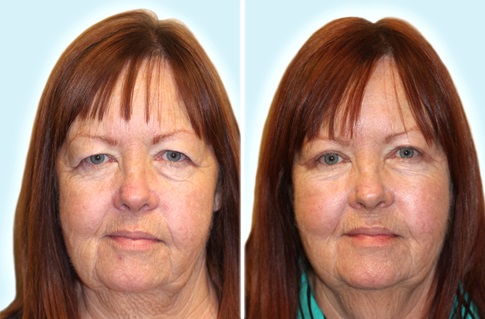 upper eyelid procedure example 1