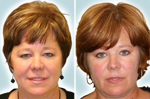 upper eyelid procedure example 2